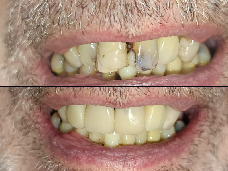 Carillas dentales estéticas de resina compuesta en Chile