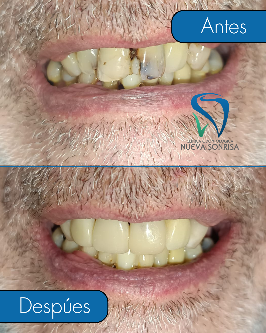 Carillas y provisorio fijo dental antes y después