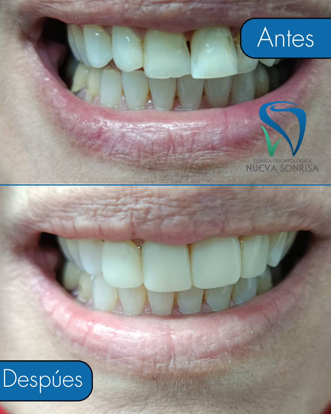 Carillas y blanqueamiento dental antes y después