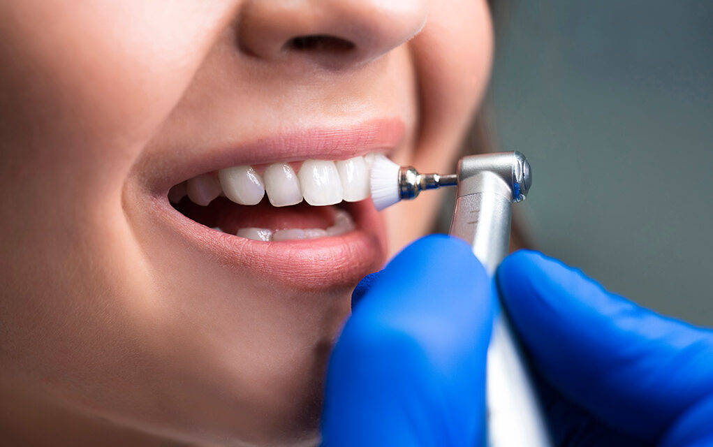 Limpieza dental profesional